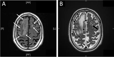 Progressive multifocal leukoencephalopathy associated with chemotherapy induced lymphocytopenia in solid tumors – case report of an underestimated complication